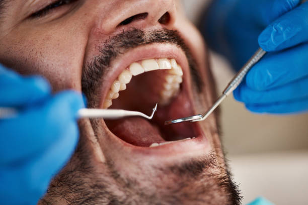 Best Emergency Treatment for Dental Infections or Abscesses in Rustburg, VA